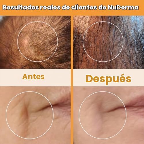 Pure Daily Care NuDerma Varita Manual para Terapia de la Piel con N...