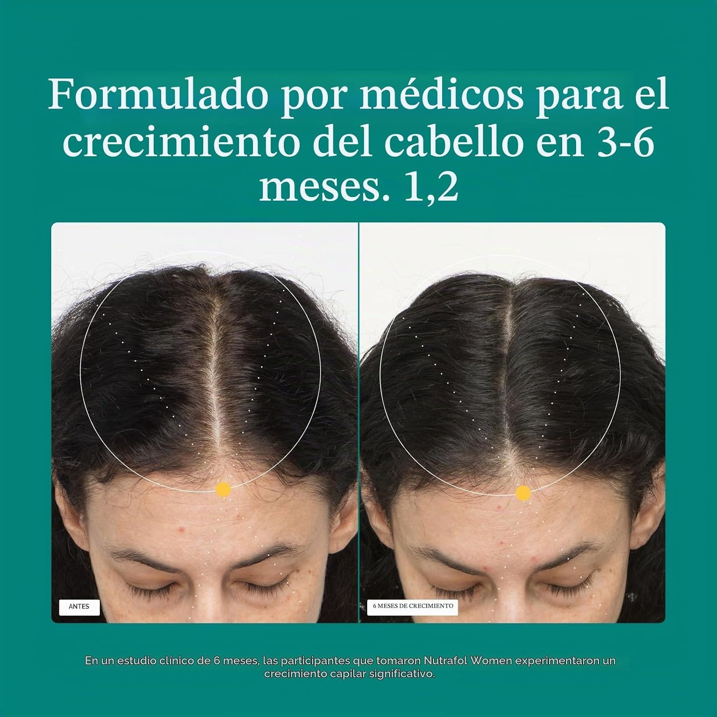 Nutrafol - Suplementos de crecimiento del cabello para mujeres de 1...
