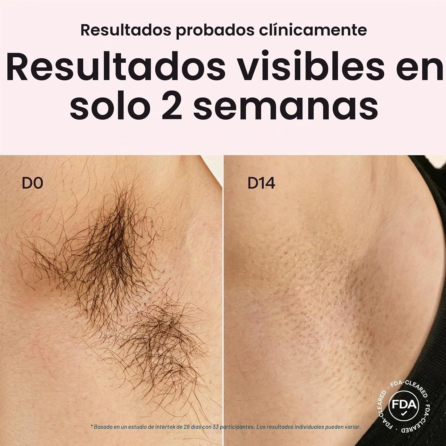 Wavytalk Dispositivo de depilación IPL, Bare It con rodillo de prec...