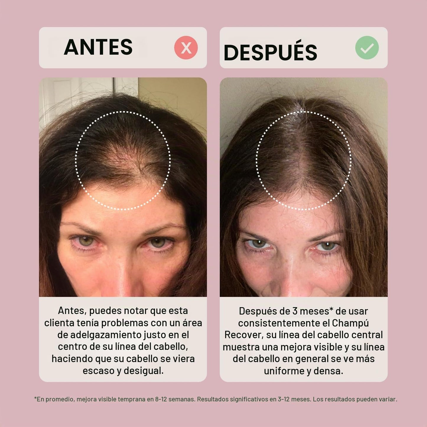 ACTIIV Recover Tratamiento de Champú Densificante para Mujeres | Ap...