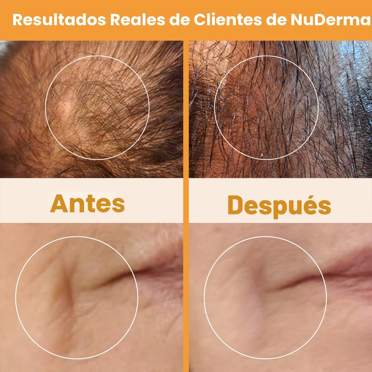 NuDerma - Máquina portátil de terapia de piel de mano, con neón, an...