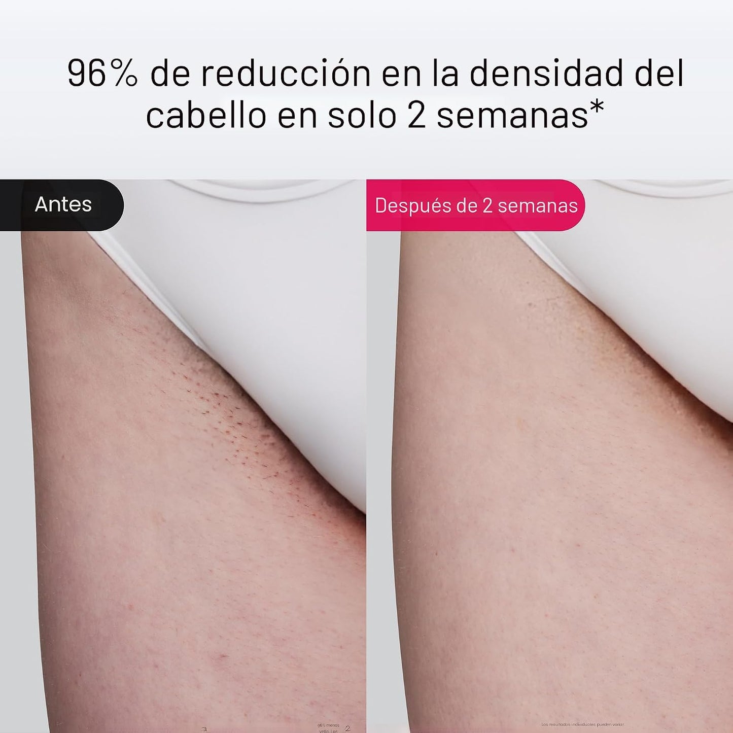 Ulike Depilación Láser Air 10 Versión Deluxe IPL para Mujeres y Hom...