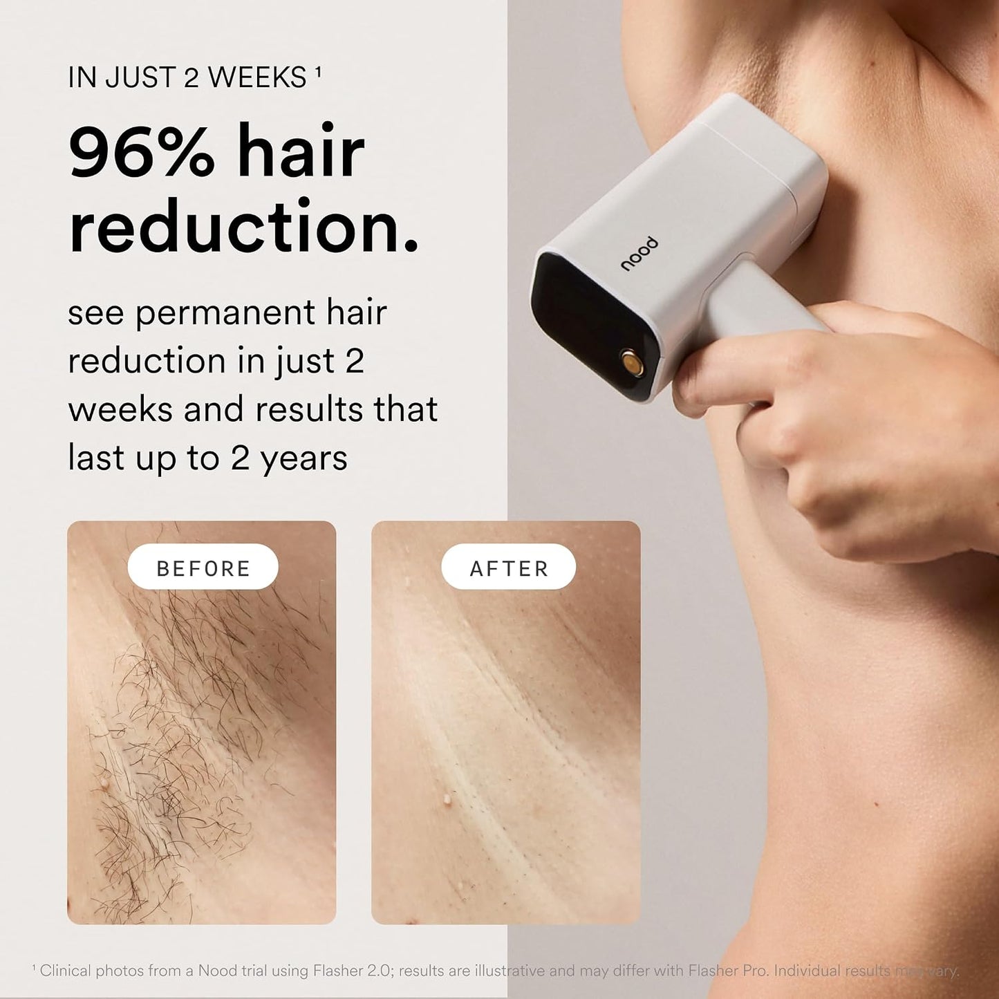 Kit Nood™ Flasher Pro | Dispositivo de depilación láser IPL con cui...