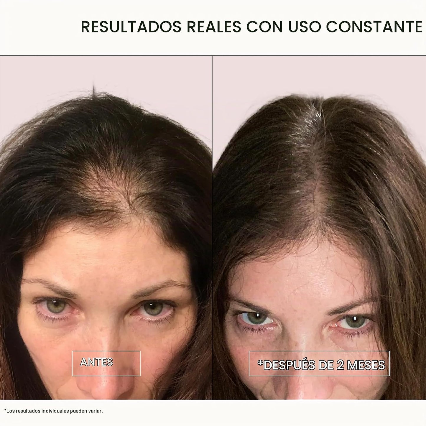ACTIIV Recover Tratamiento de Champú Densificante para Mujeres | Ap...