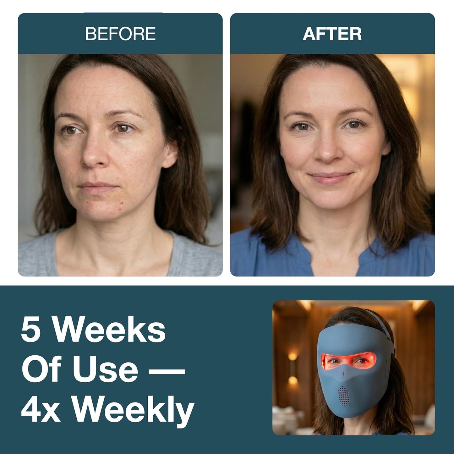 myhalos® Máscara Facial de Terapia de Luz Roja - Dispositivo de Ter...